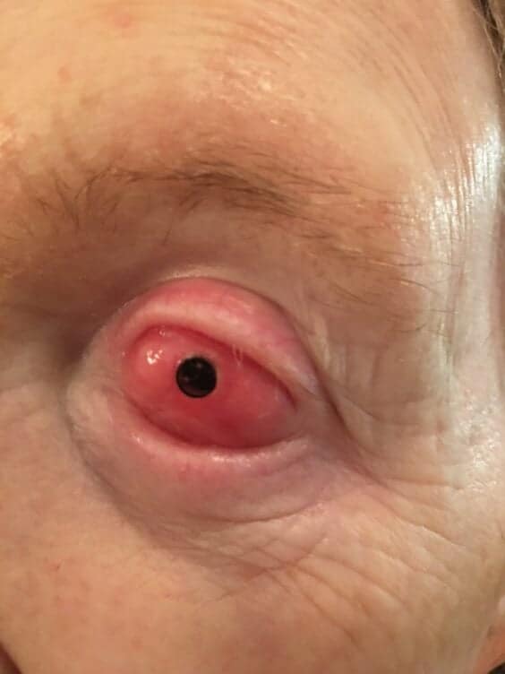 A patient’s eye after the tooth has been surgically implanted over the eyeball in “tooth-in-eye” surgery. Photo courtesy Dr. Greg Moloney, Providence Health Care